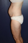 Tummy Tuck Patient 32584 Photo 1