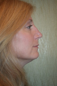 Rhinoplasty Patient 24779 Photo 4