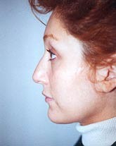 Rhinoplasty Patient 97985 Photo 1