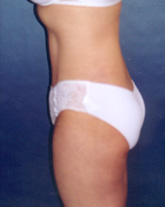 Tummy Tuck Patient 64354 Photo 4