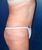 Tummy Tuck Patient 49099 Photo 2