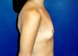 Breast Augmentation Patient 27898 Photo 3