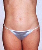 Liposculpture/Liposuction Patient 34954 Photo 2