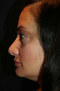 Rhinoplasty Patient 77758 Photo 2