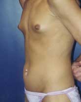 Breast Augmentation Patient 60821 Photo 3