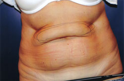 Liposculpture/Liposuction Patient 90722 Photo 1