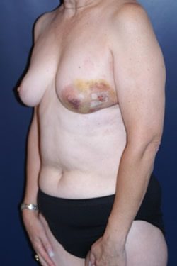 Breast Reconstruction Patient 11840 Photo 1