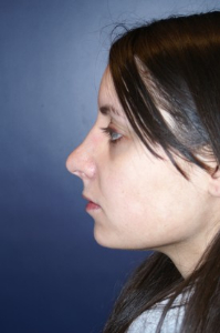 Rhinoplasty Patient 60210 Photo 4