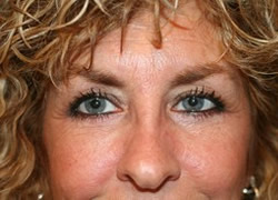 Brow Lift Patient 27228 Photo 4