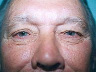 Eyelid Surgery Patient 71639 Photo 1