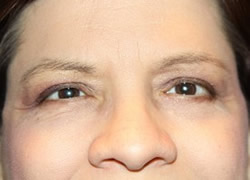 Eyelid Surgery Patient 75584 Photo 4