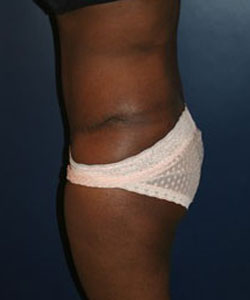 Tummy Tuck Patient 59616 Photo 4