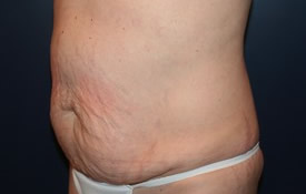 Tummy Tuck Patient 27475 Photo 1