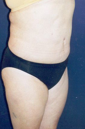 Tummy Tuck Patient 33040 Photo 6