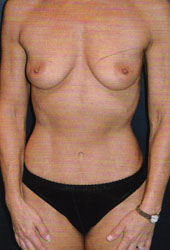 Breast Augmentation Patient 41416 Photo 1