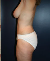 Tummy Tuck Patient 96601 Photo 2