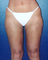 Liposculpture/Liposuction Patient 73218 Photo 2