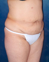 Tummy Tuck Patient 34643 Photo 3