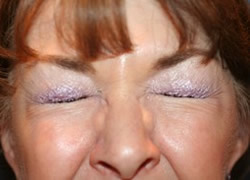 Eyelid Surgery Patient 83648 Photo 3