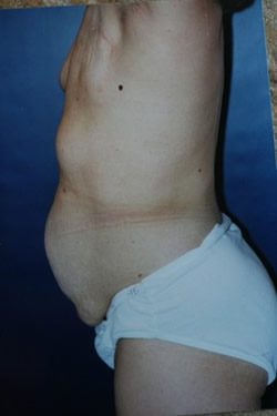 Breast Reconstruction Patient 85288 Photo 1