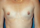 Breast Augmentation Patient 54752 Photo 1