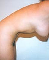 Liposculpture/Liposuction Patient 62646 Photo 2