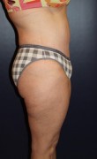 Tummy Tuck Patient 95363 Photo 2