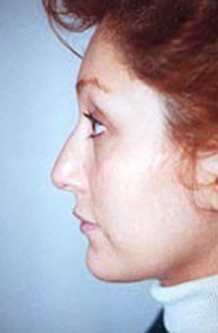 Chin Augmentation Patient 48467 Photo 1