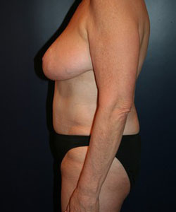 Tummy Tuck Patient 36848 Photo 4