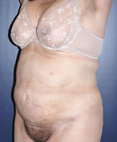 Liposculpture/Liposuction Patient 88624 Photo 4