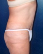 Tummy Tuck Patient 31720 Photo 2