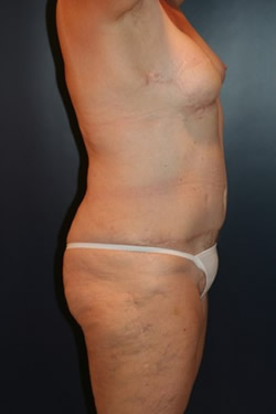 Breast Reconstruction Patient 35726 Photo 4