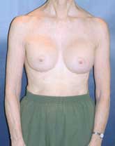 Breast Augmentation Patient 22537 Photo 2