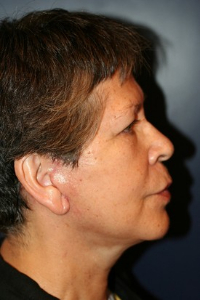 Facelift Patient 72436 Photo 2