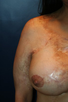 Breast Reconstruction Patient 76022 Photo 4