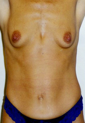 Tummy Tuck Patient 87102 Photo 3