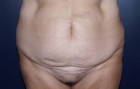 Tummy Tuck Patient 82205 Photo 1