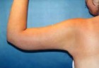 Arm Liposuction Patient 23064 Photo 2