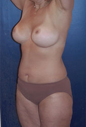 Breast Augmentation Patient 50635 Photo 6