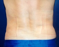 Male Liposuction Patient 64775 Photo 4