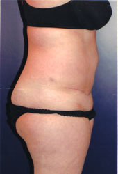 Tummy Tuck Patient 98082 Photo 4