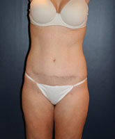 Liposculpture/Liposuction Patient 24722 Photo 4