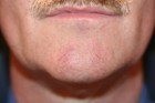 Laser Telengiectasia Blood Vessels Patient 20951 Photo 1