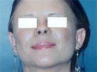 Otoplasty Patient 35144 Photo 1