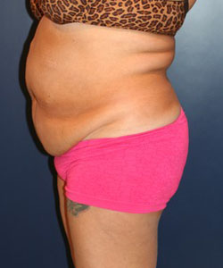 Tummy Tuck Patient 29857 Photo 1