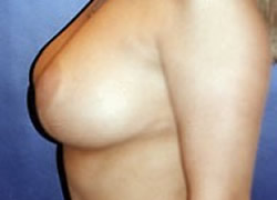 Breast Reduction Patient 81037 Photo 4