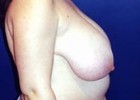 Breast Lift Patient 14022 Photo 1