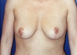 Breast Lift Patient 56914 Photo 2