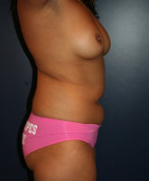 Liposculpture/Liposuction Patient 28942 Photo 3