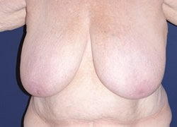 Breast Reduction Patient 28581 Photo 1
